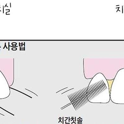 이빨 관리가 ㅈ같은 이유.